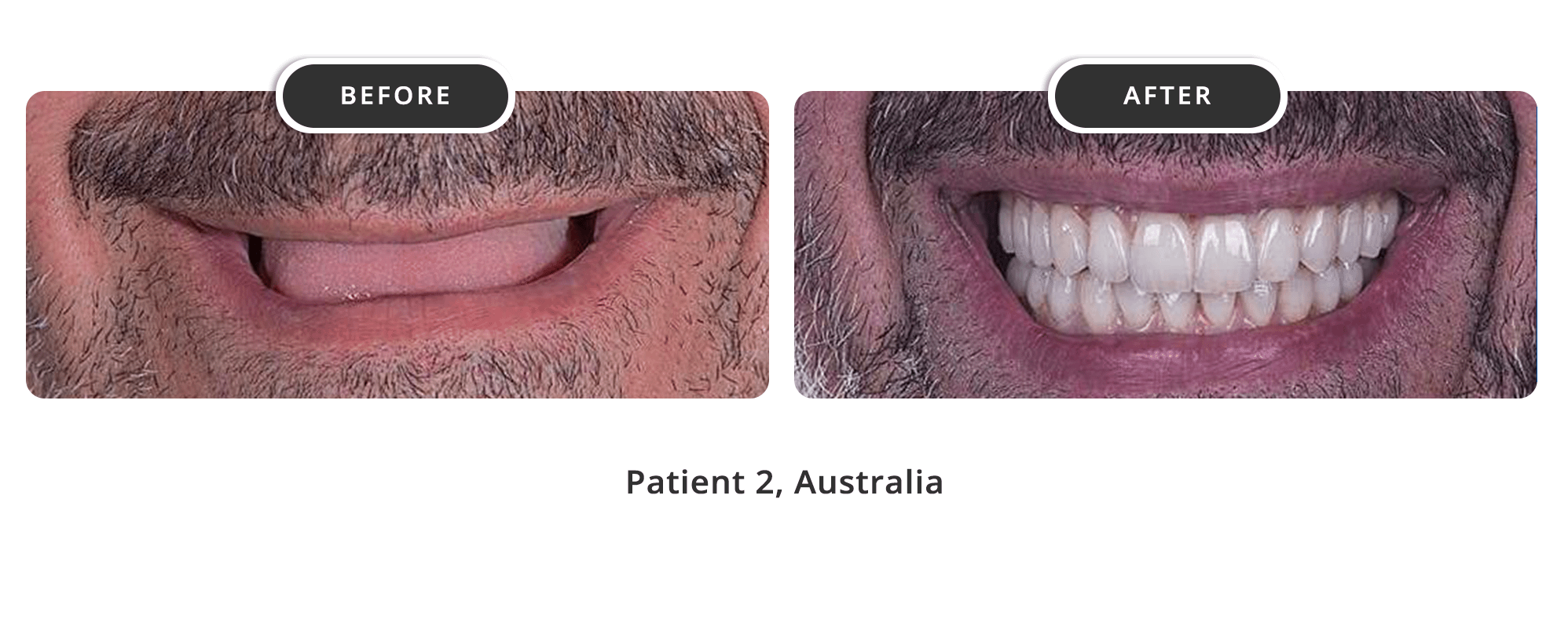 Dental Implants 2