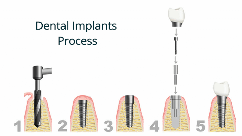 Dental Implants – Gaindia